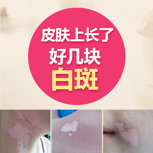 成都治白癜风哪家医院最好