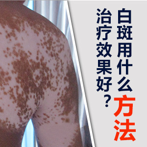 成都白癜风哪个医院好