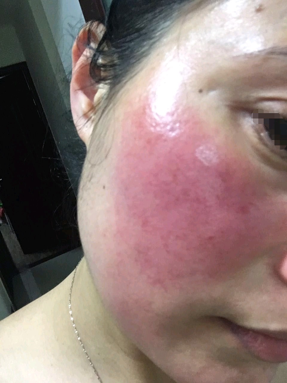 脸部严重泛红长疹可能是这4种皮肤病