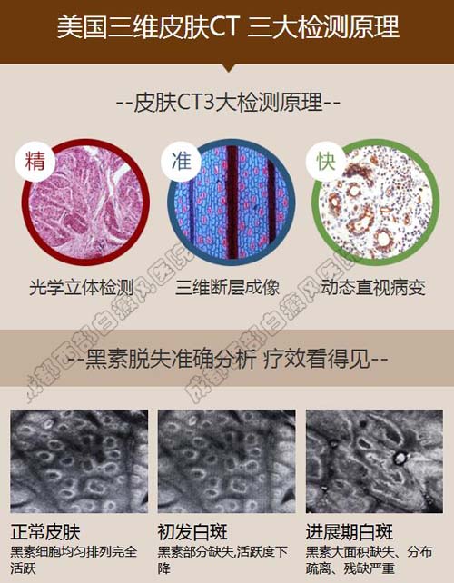 成都白癜风哪个医院好