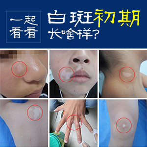 成都白癜风哪个医院好