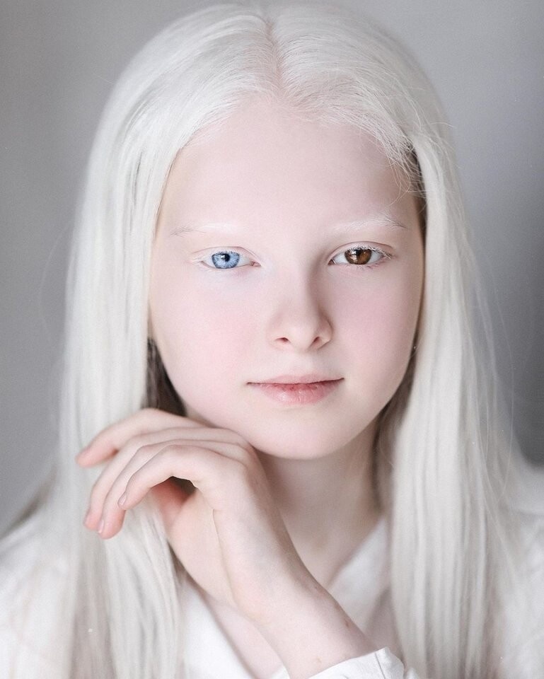 一眼冰雪,一眼森林…这个白化病 异色瞳的俄罗斯少女让网友震惊了