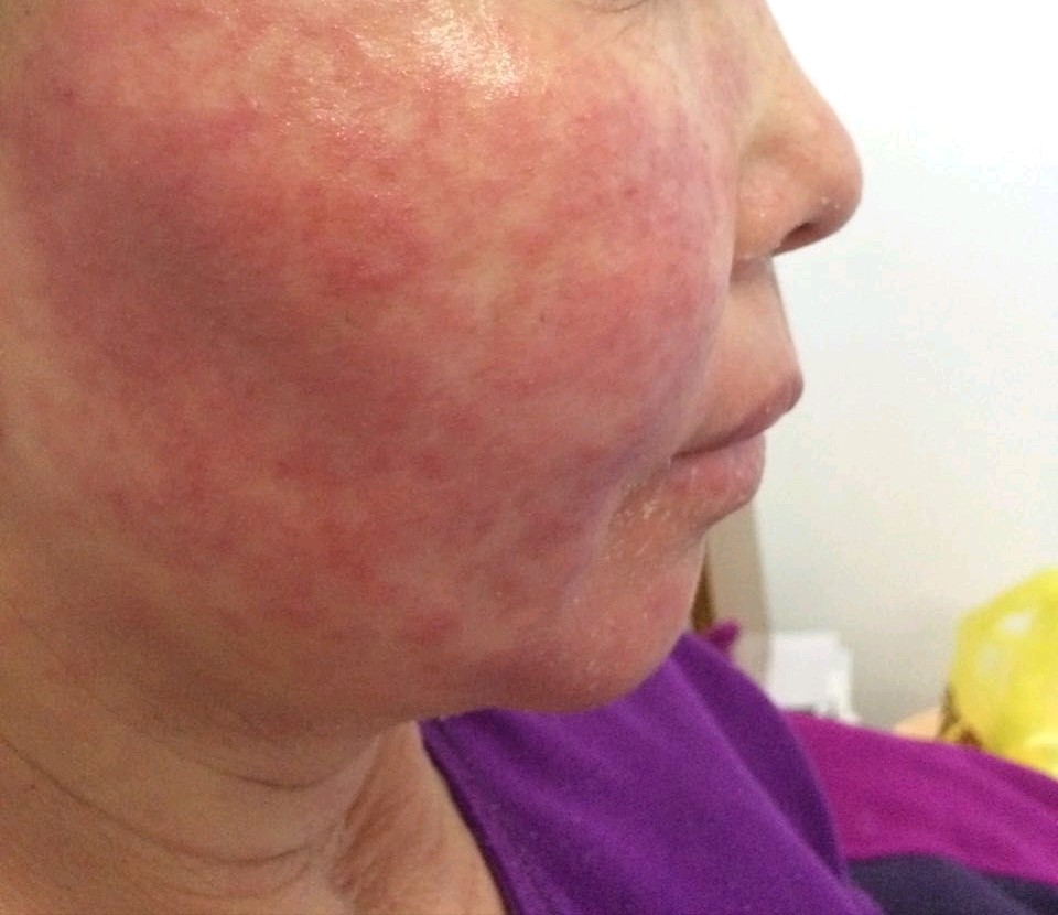 脸部严重泛红长疹,可能是这4种皮肤病!