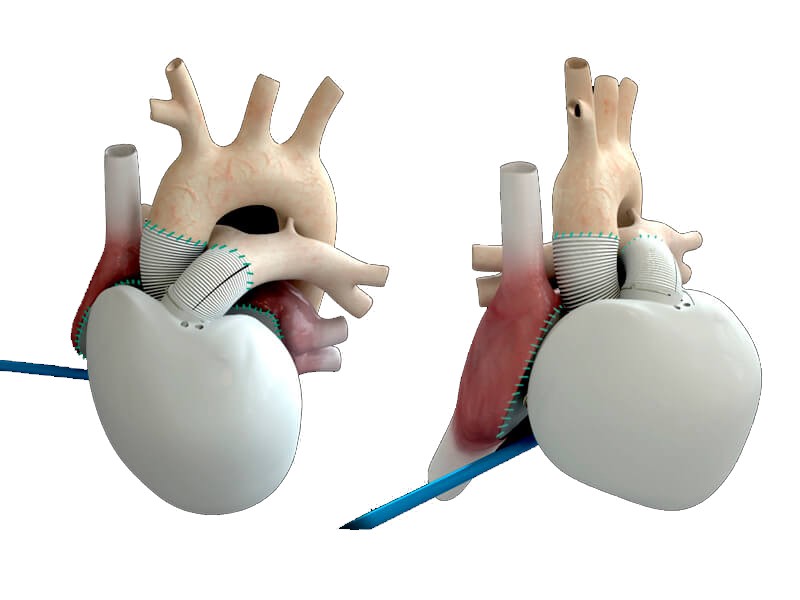 artificial-heart-failure-carmat-1.jpg