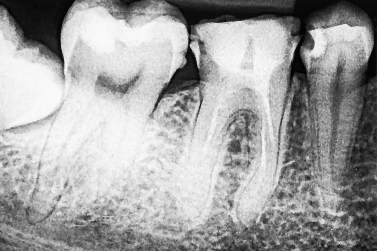 图3-67 下颌乳尖牙-口腔颌面及颈部临床解剖学-医学