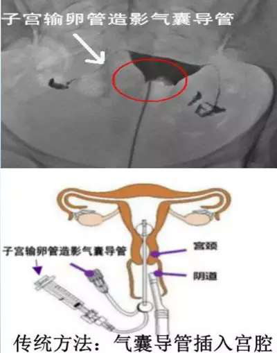 输卵管造影检查步骤图片