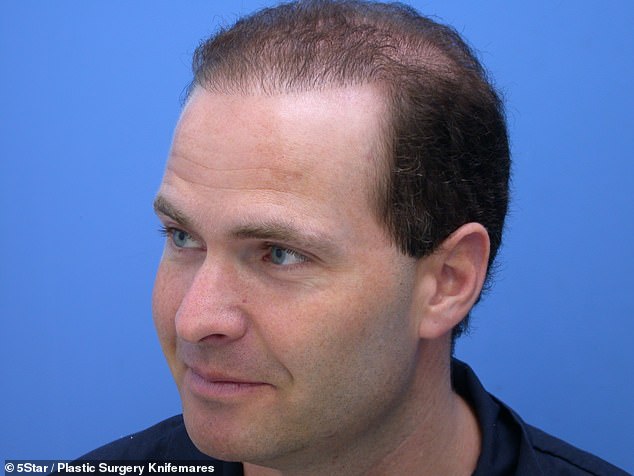 31916234-0-After_years_of_treatment_the_result_of_David_s_hair_transplant_p-a-29_1597337313819.jpg