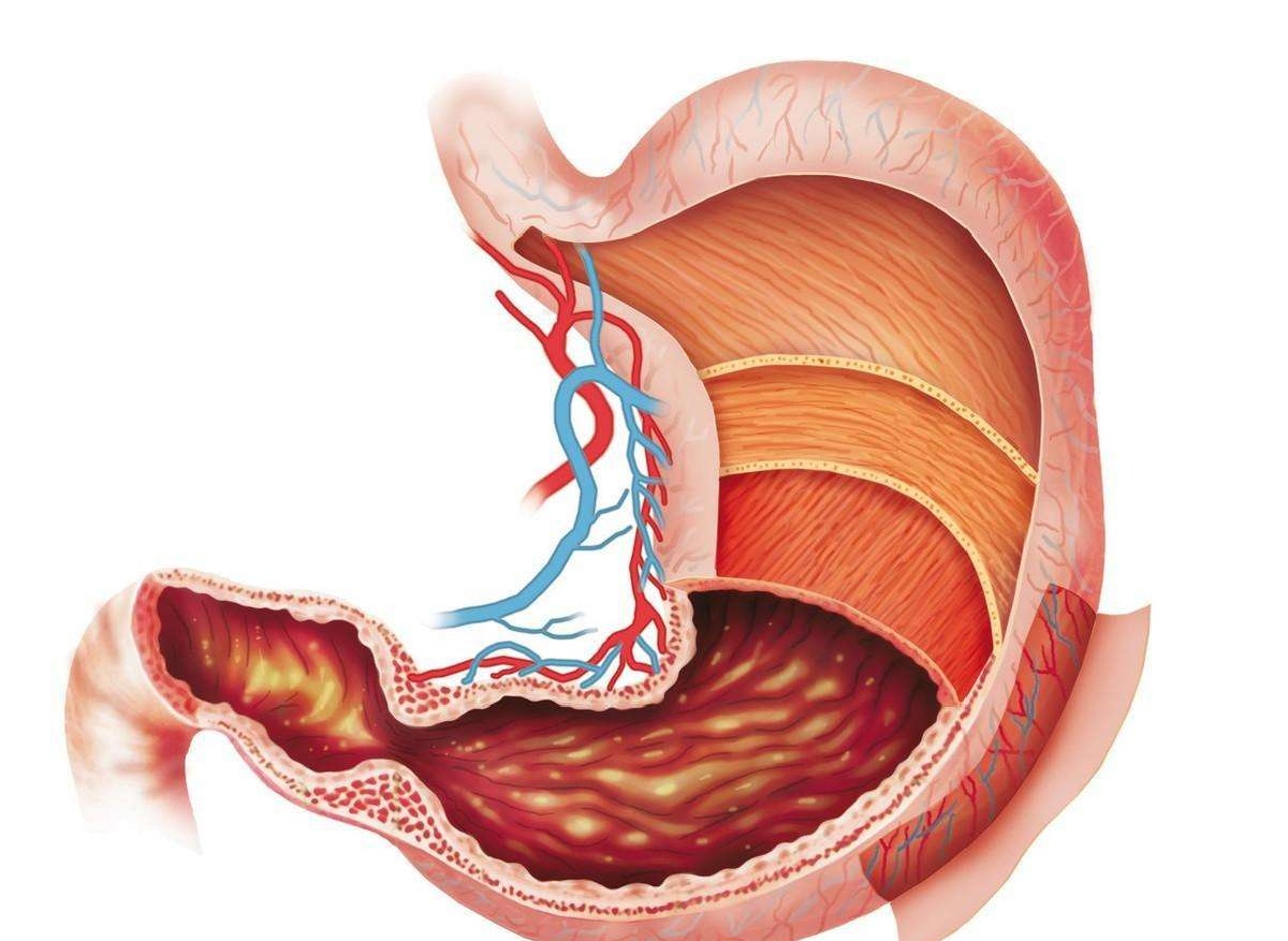 胃的图片 幽门图片